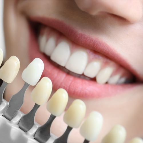 Bleaching Zahnaufhellung Berlin Hohenschönhausen - P4 Die Zahnärzte