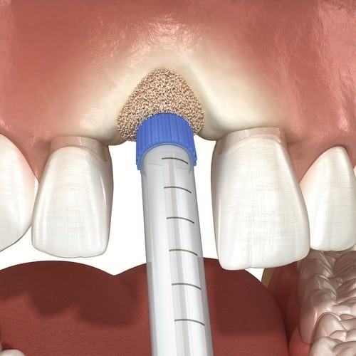 Knochenaufbau be Kieferknoschenschwund - P4 Die Zahnärzte Berlin Hohenschöhnhausen