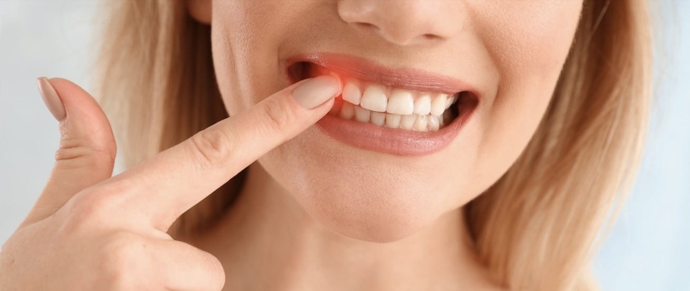 Parodontitis erhöht Risiko für andere Krankheiten - P4 Zahnärzte in Berlin Hohenschönhausen