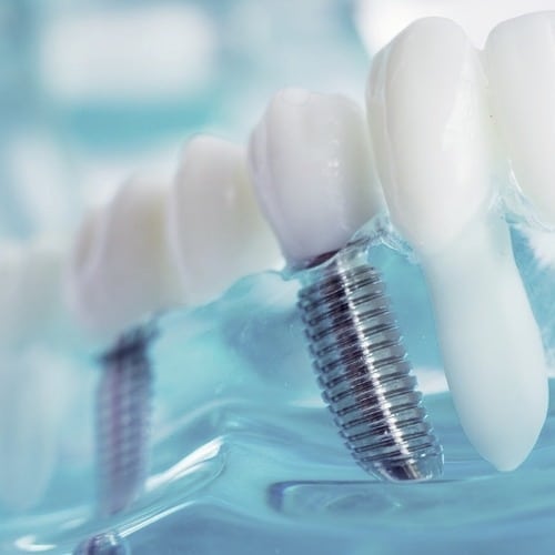 Zahnimplantate - Implantologie Berlin Hohenschönhausen - P4 Zahnärzte