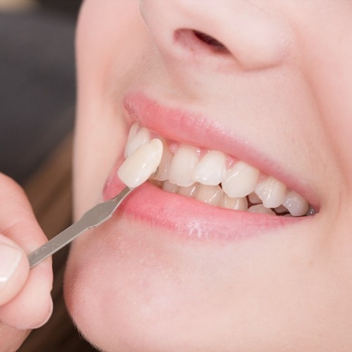 Zahnveneers - Keramik Verblendschalen Berlin Hohenschönhausen - P4 Zahnärzte